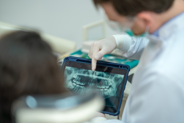 Important Information About Root Canal Therapy